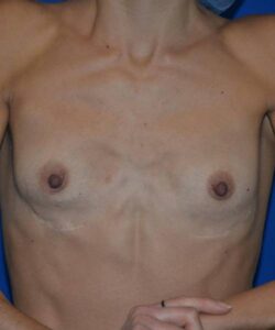 before breast revision front view case 4539