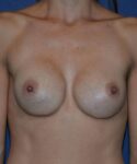 after breast revision surgery front view case 4539