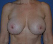 After Breast Revision Surgery Female Patient Front Angle View Case 4544