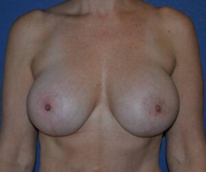 After Breast Revision Surgery Female Patient Front Angle View Case 4544