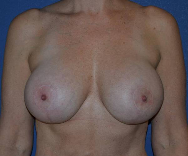 After Breast Revision Surgery Female Patient Front Angle View Case 4544