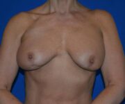 Before Breast Revision Surgery Female Patient Front Angle flexed View Case 4544