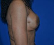 After Breast Revision Surgery Female Patient Side Angle View Case 4556