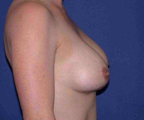 Before Breast Revision Surgery Female Patient Side Angle View Case 4569