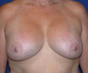 Before Breast Revision Surgery Female Patient Front Angle View Case 4576