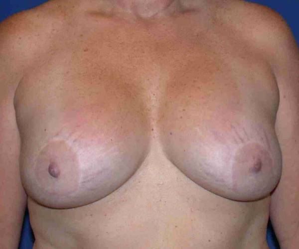 Before Breast Revision Surgery Female Patient Front Angle View Case 4576
