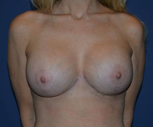 After Breast Revision Surgery Female Patient Front Angle flexed View Case 4597