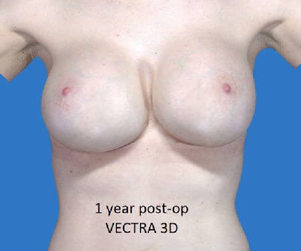 After Breast Revision Surgery Female Patient Front Angle View Case 4618