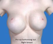 Before Breast Revision Surgery Female Patient Front Angle View Case 4618