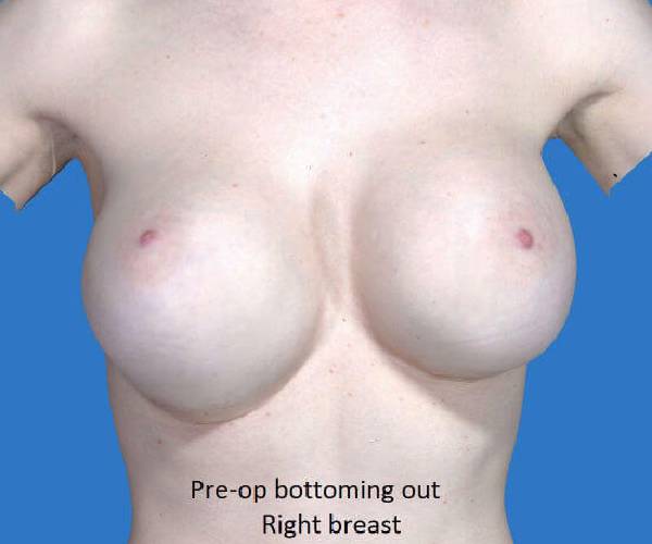 Before Breast Revision Surgery Female Patient Front Angle View Case 4618