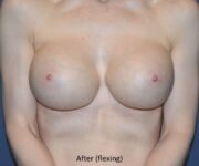 After Breast Revision Surgery Female Patient Front Angle flexing View Case 4618