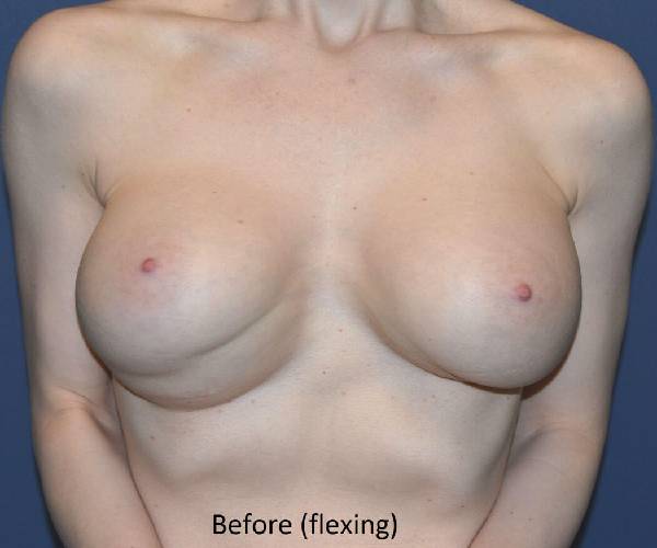 Before Breast Revision Surgery Female Patient Front Angle flexing View Case 4618