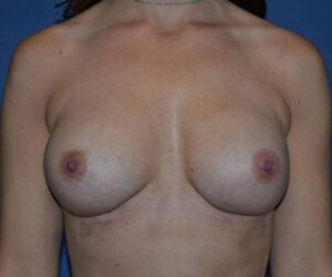 After Breast Revision Surgery Female Patient Front Angle View Case 4623