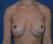 Before Breast Revision Surgery Female Patient Front Angle View Case 4623