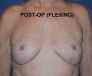 After Breast Revision Surgery Female Patient Front Angle flexed View Case 4642