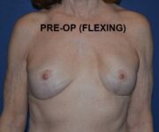 Before Breast Revision Surgery Female Patient Front Angle flexed View Case 4642