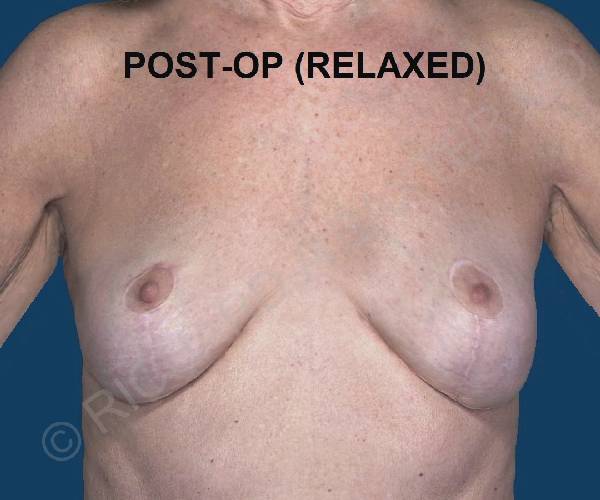 After Breast Revision Surgery Female Patient Front Angle View Case 4642