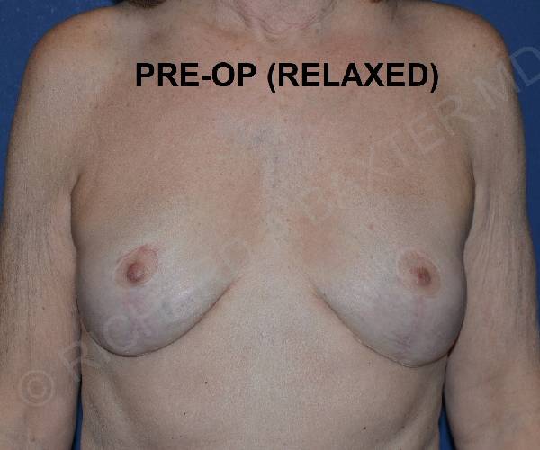 Before Breast Revision Surgery Female Patient Front Angle View Case 4642