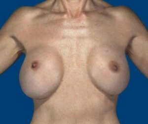 Before Breast Revision Surgery Female Patient Front Angle View Case 4647