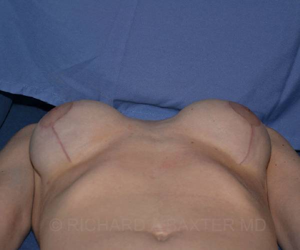 After Breast Revision Surgery Female Patient OR View Case 4654