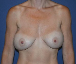 Before Breast Revision Surgery Female Patient Front Angle View Case 4657