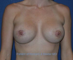 After Breast Revision Surgery Female Patient Front Angle View Case 4662