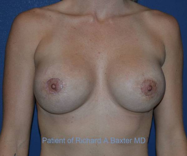 After Breast Revision Surgery Female Patient Front Angle View Case 4662