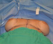 Before Breast Revision Surgery Female Patient OR View Case 4662
