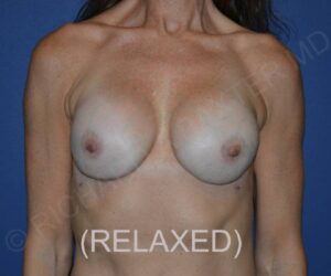 After Breast Revision Surgery Female Patient Front Angle View Case 4667