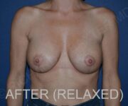 After Breast Revision Surgery Female Patient Front Angle View Case 4676