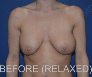 Before Breast Revision Surgery Female Patient Front Angle View Case 4676
