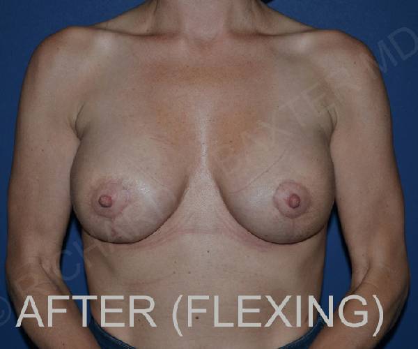 After Breast Revision Surgery Female Patient Front Angle flexed View Case 4676