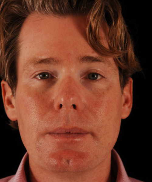 after brow lift | forehead lift male patient front view case 5267