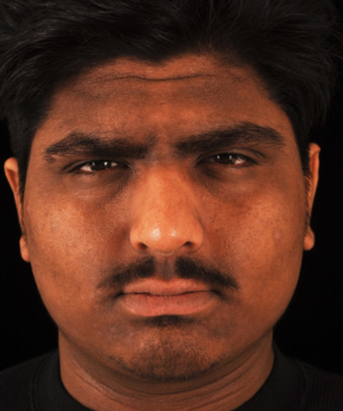 before brow lift | forehead lift male patient front view case 5270