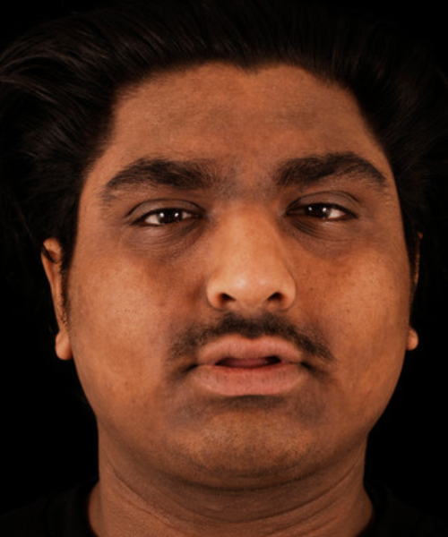 after brow lift | forehead lift male patient front view case 5270