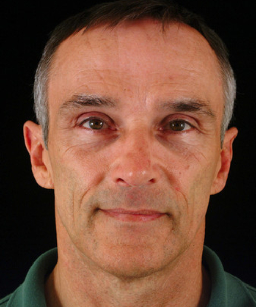 after brow lift | forehead lift male patient front view case 5276