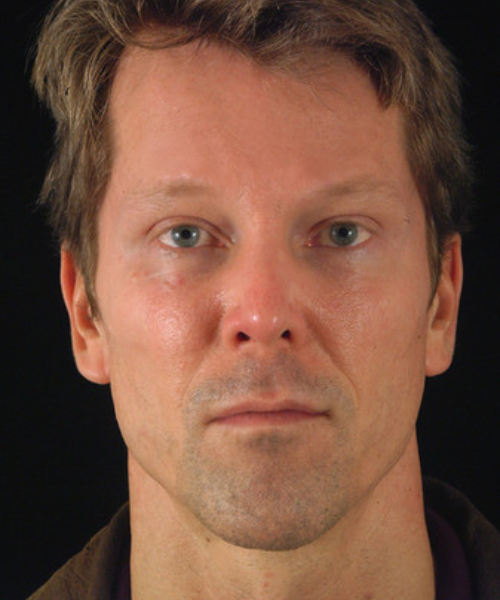 after brow lift | forehead lift male patient front view case 5279