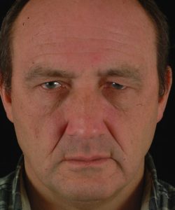 before brow lift | forehead lift male patient front view case 5285