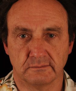 after brow lift | forehead lift male patient front view case 5285