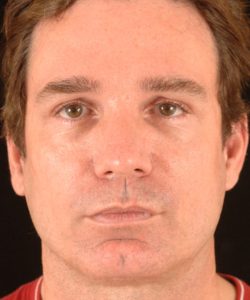 after brow lift | forehead lift male patient front view case 5288