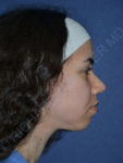 before chin implant female patient right side view case 4083