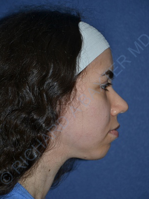 before chin implant female patient right side view case 4083