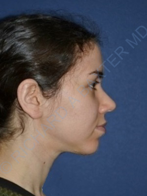 after chin implant female patient right side view case 4083