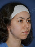 before chin implant right angle view case 4083