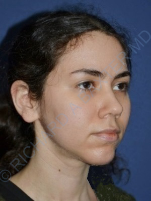 after chin implant female patient right angle view case 4083