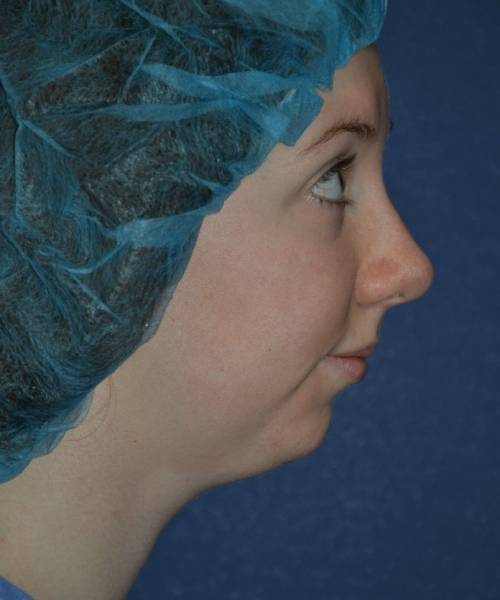 before chin implant female patient right side view case 4088