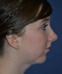 after chin implant female patient right side view case 4088