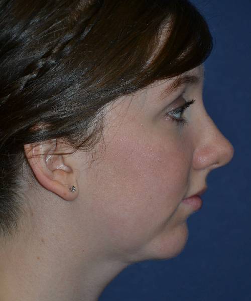 after chin implant female patient right side view case 4088