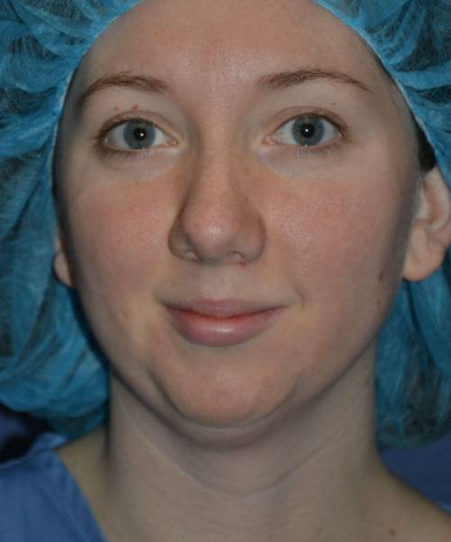 before chin implant female patient front view case 4088