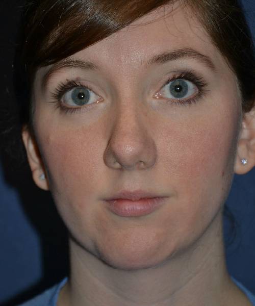 after chin implant female patient front view case 4088